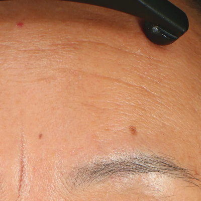BEFORE FOREHEAD LINES