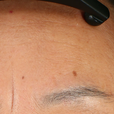 AFTER FOREHEAD LINES