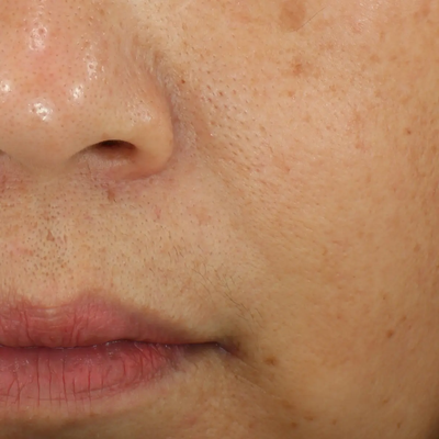 BEFORE NASOLABIAL FOLDS