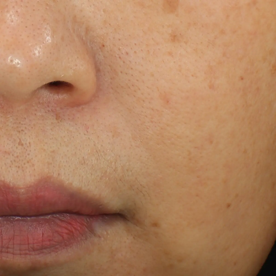 AFTER NASOLABIAL FOLDS